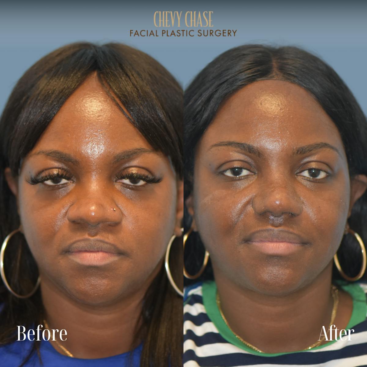 Rhinoplasty Before & After Gallery - Patient 355938 - Image 2