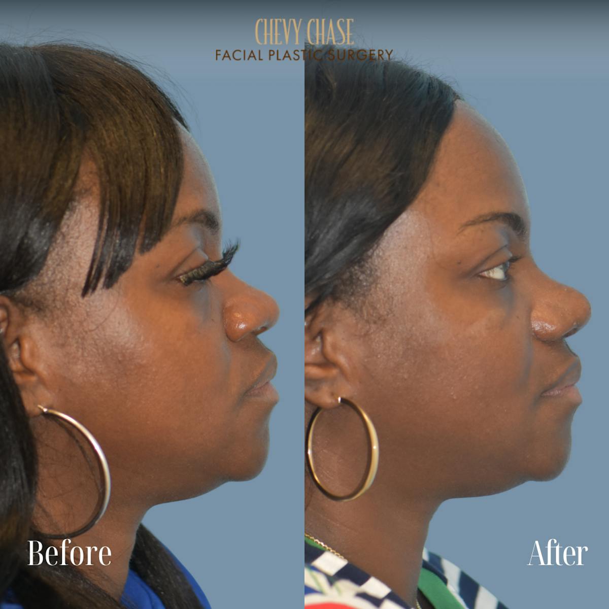 Rhinoplasty Before & After Gallery - Patient 355938 - Image 5
