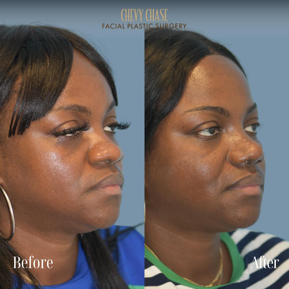 Rhinoplasty Before & After Gallery - Patient 355938 - Image 4