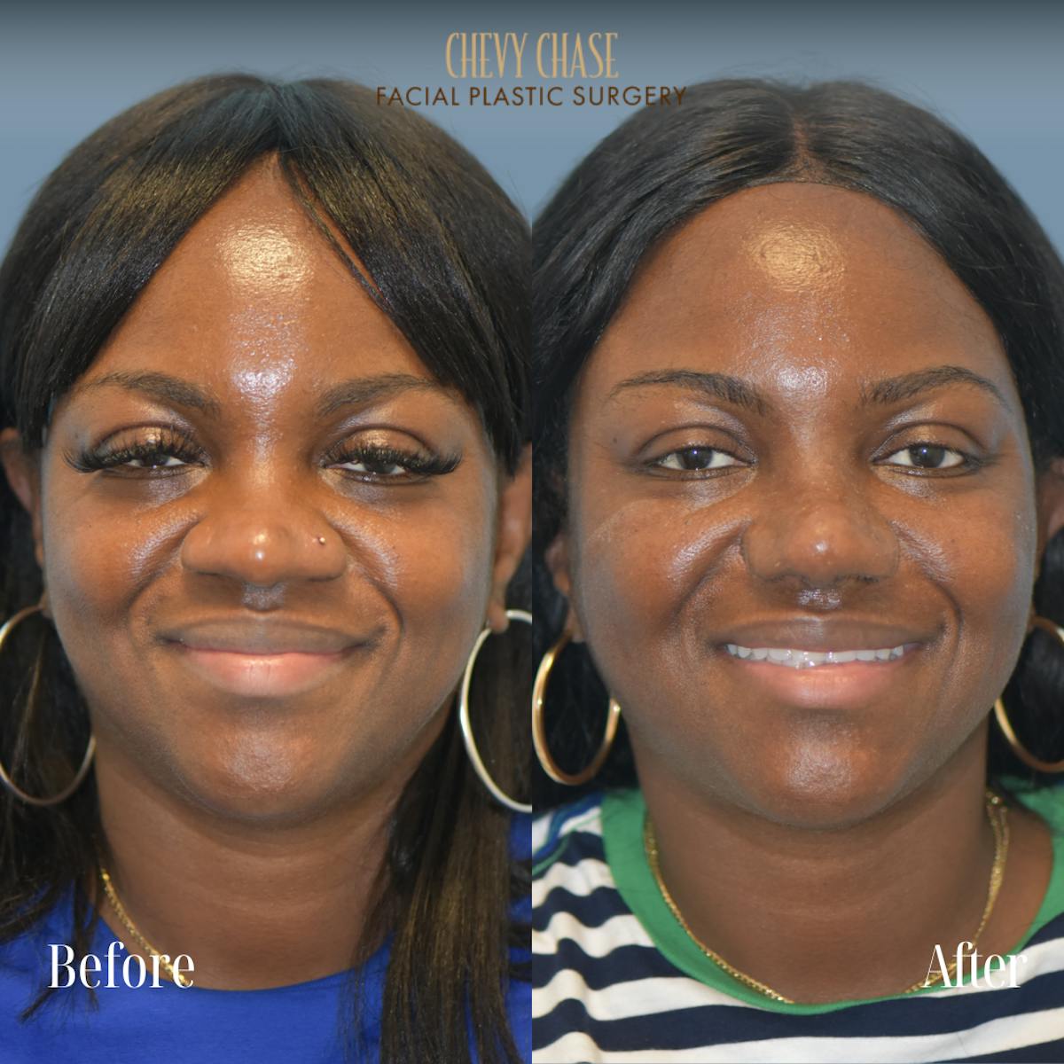 Rhinoplasty Before & After Gallery - Patient 355938 - Image 3