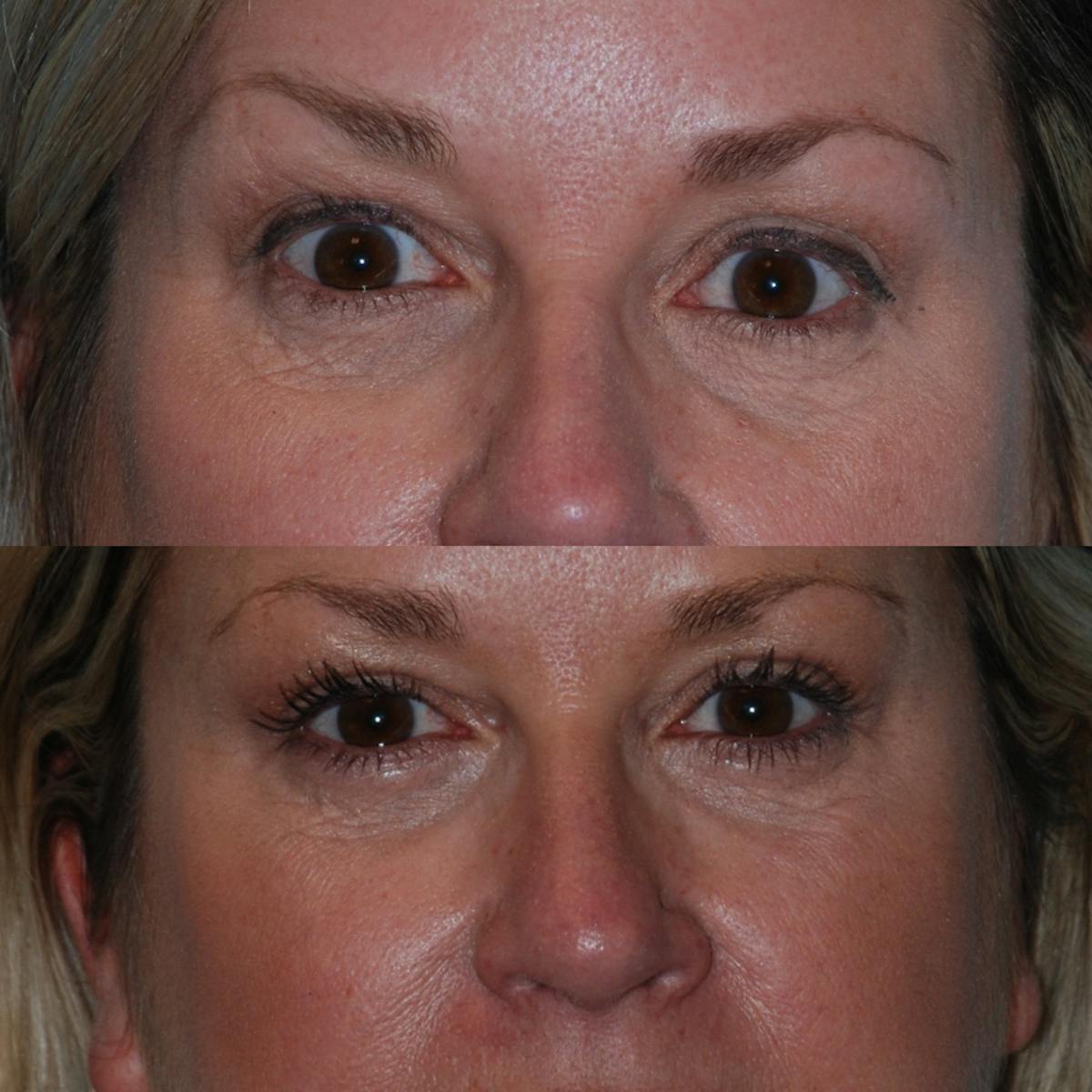 Blepharoplasty Before & After Gallery - Patient 376062 - Image 1