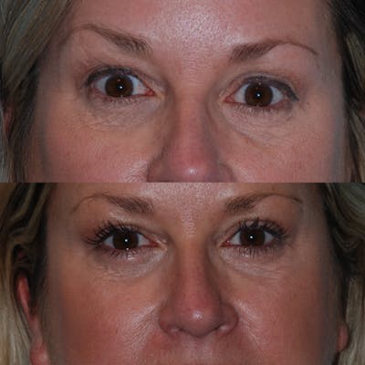 Blepharoplasty Before & After Gallery - Patient 376062 - Image 1