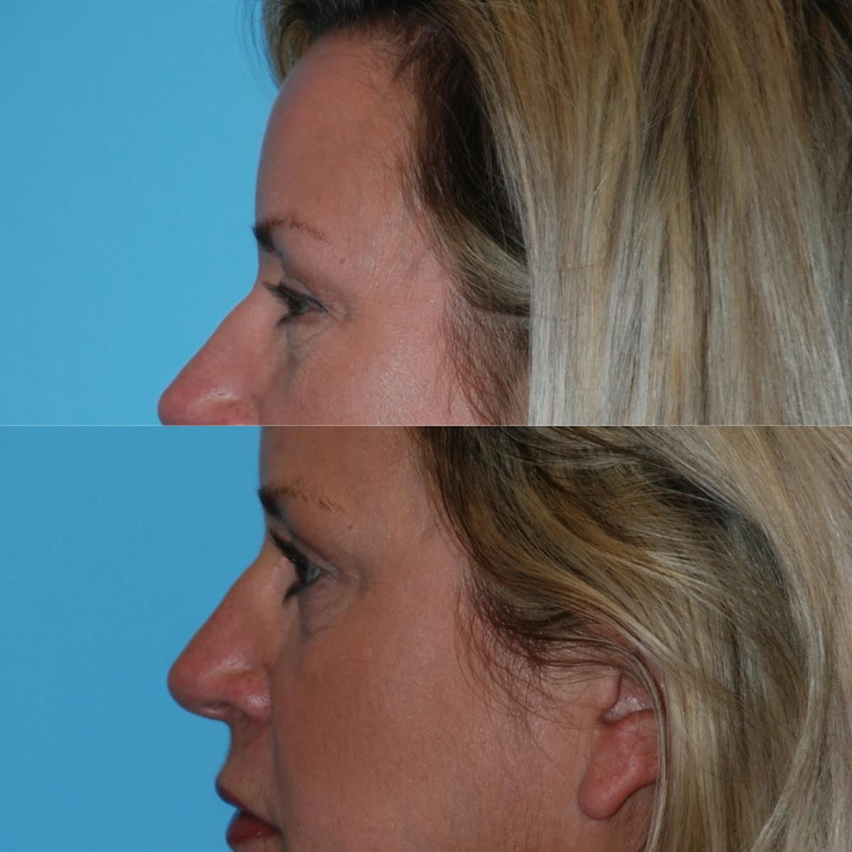 Blepharoplasty Before & After Gallery - Patient 376062 - Image 5