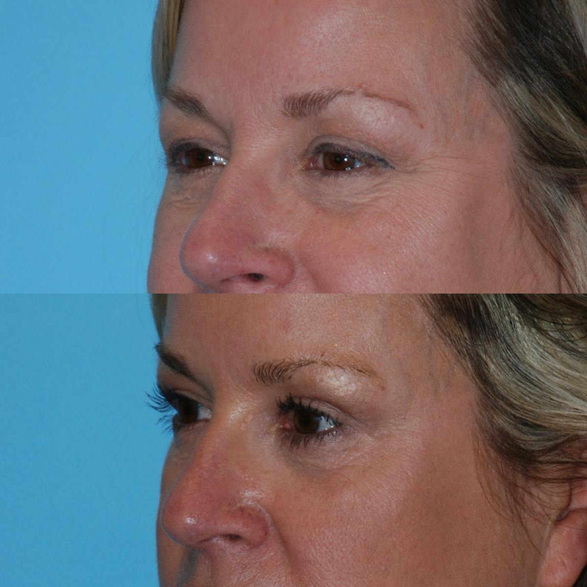 Blepharoplasty Before & After Gallery - Patient 376062 - Image 4