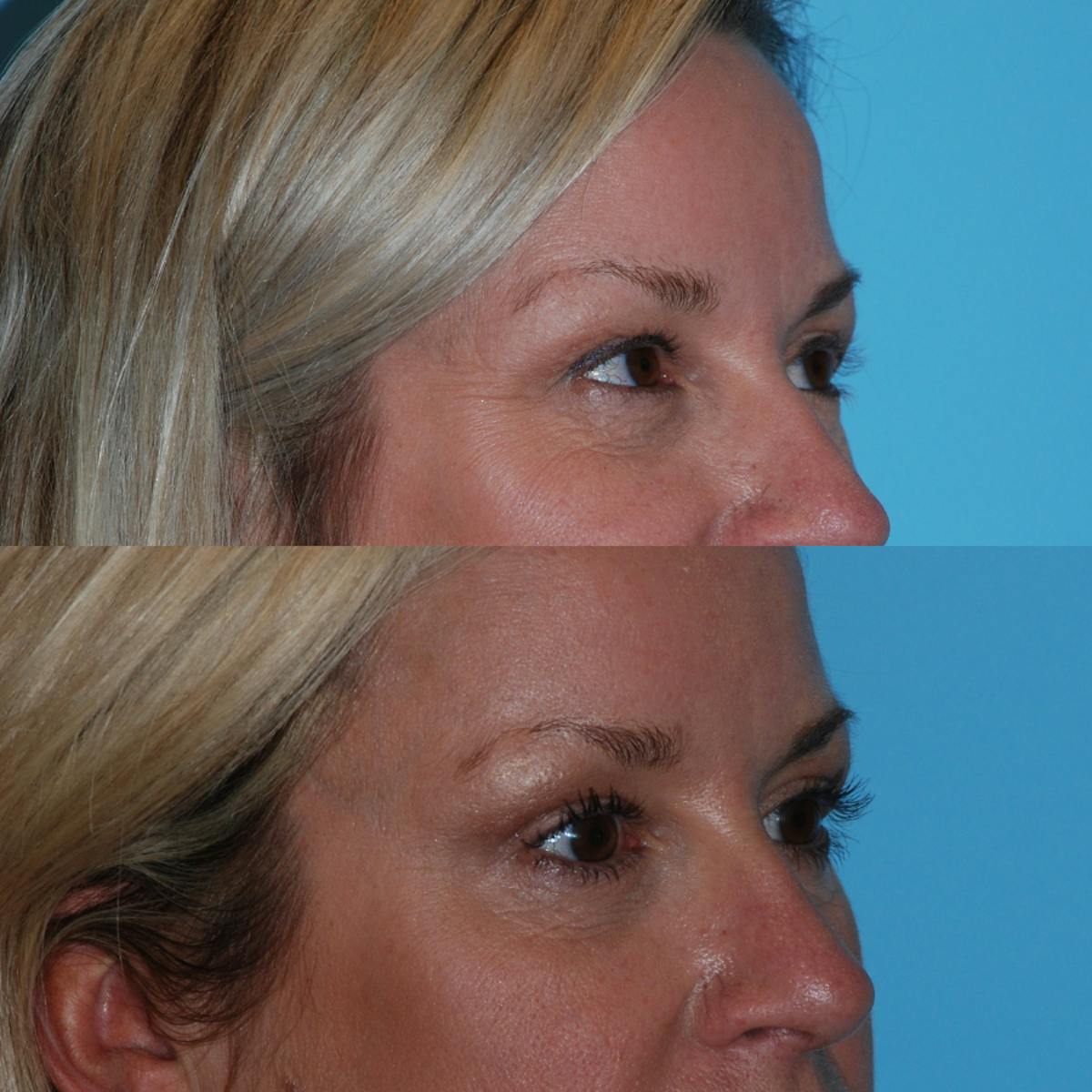 Blepharoplasty Before & After Gallery - Patient 376062 - Image 2