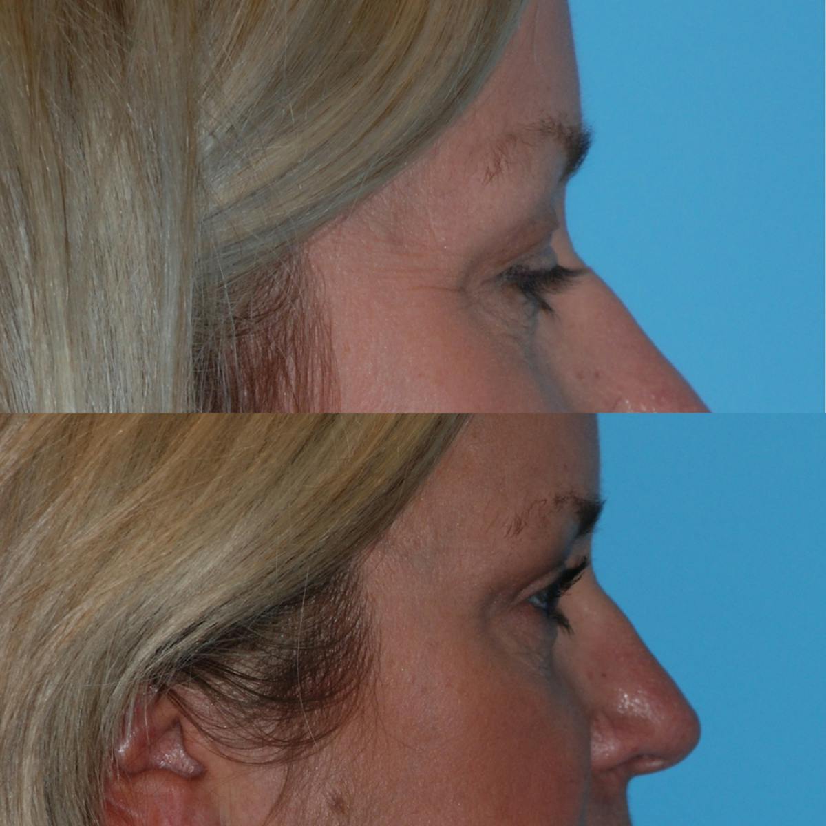 Blepharoplasty Before & After Gallery - Patient 376062 - Image 3