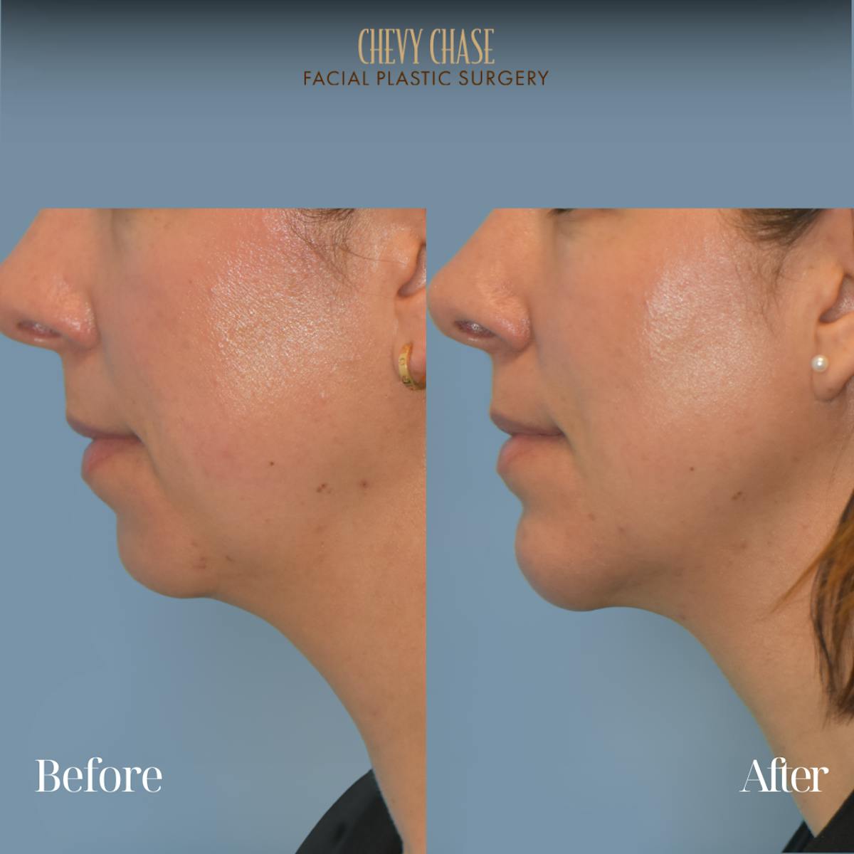 Botox® / Wrinkle Treatments Before & After Gallery - Patient 353916 - Image 2