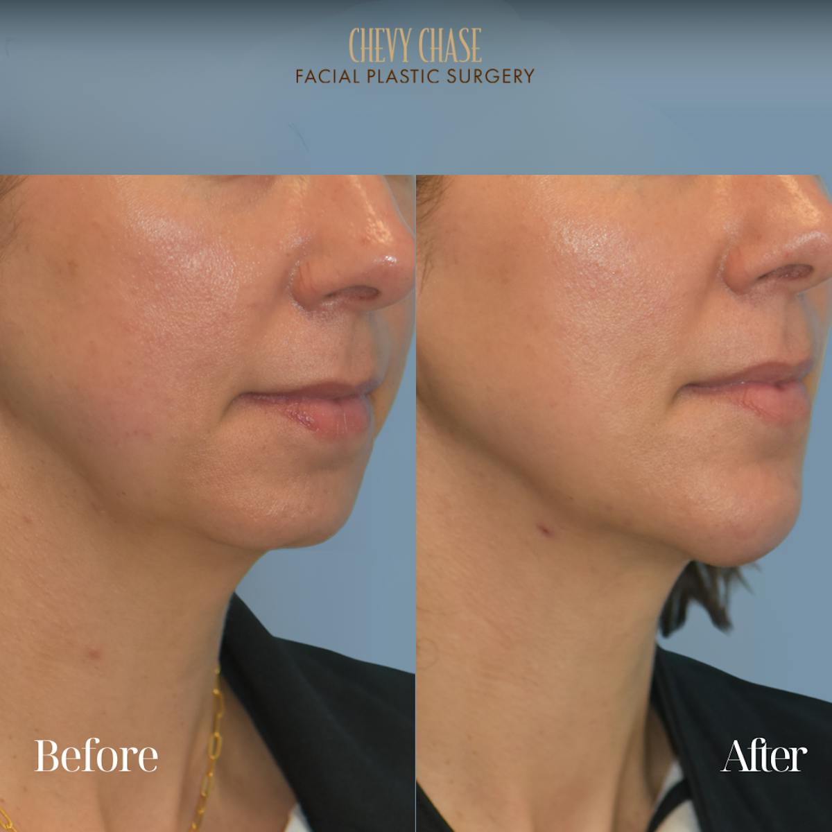 Botox® / Wrinkle Treatments Before & After Gallery - Patient 353916 - Image 1