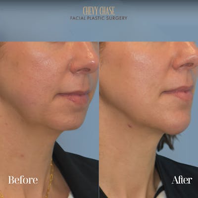 Botox® / Wrinkle Treatments Before & After Gallery - Patient 353916 - Image 1