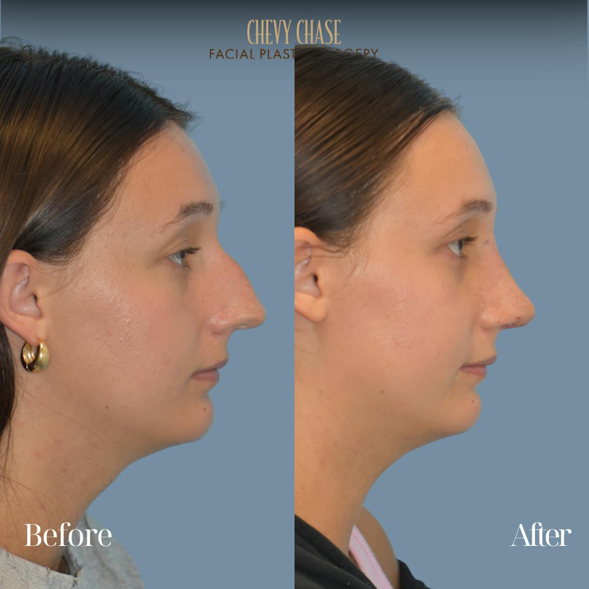 Rhinoplasty Before & After Gallery - Patient 207531 - Image 3