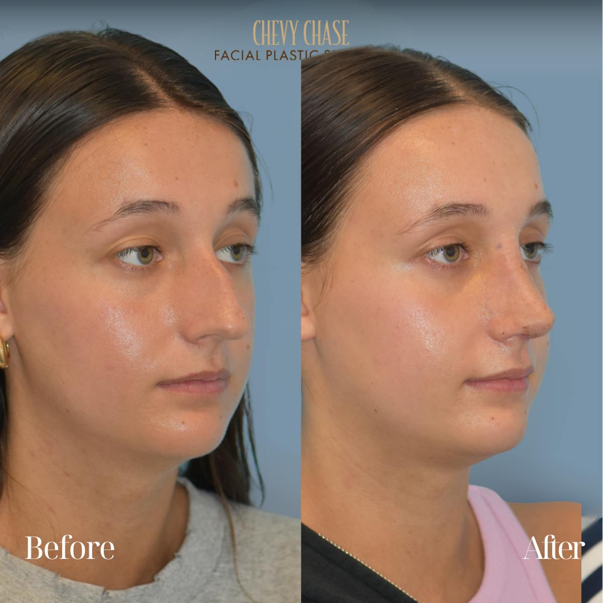 Rhinoplasty Before & After Gallery - Patient 207531 - Image 4