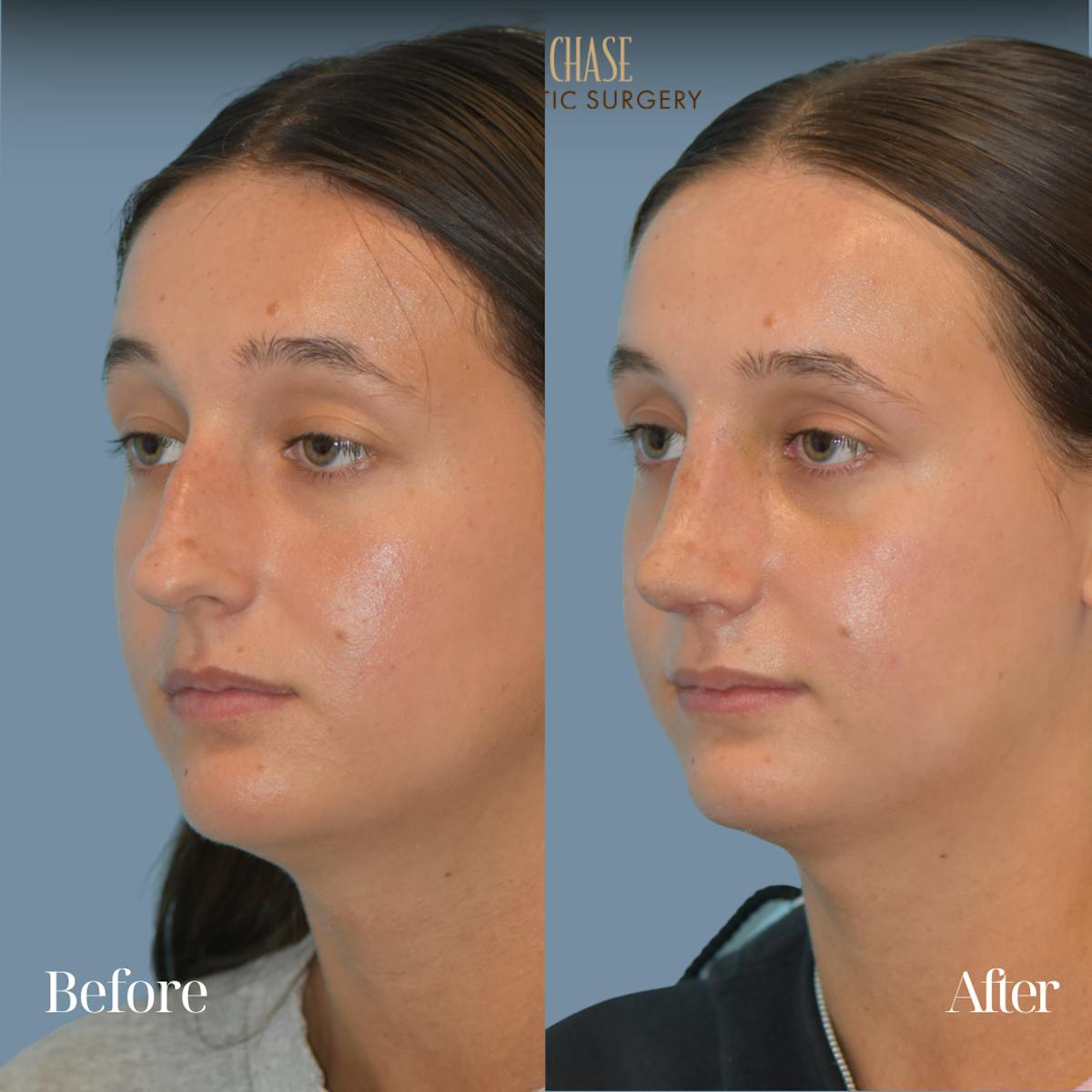 Rhinoplasty Before & After Gallery - Patient 207531 - Image 5