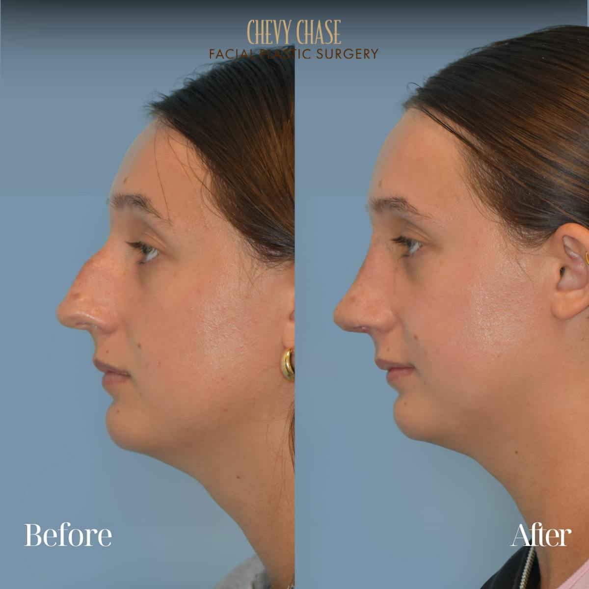 Rhinoplasty Before & After Gallery - Patient 207531 - Image 1