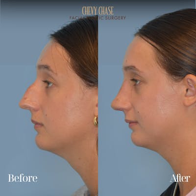 Rhinoplasty Before & After Gallery - Patient 207531 - Image 1