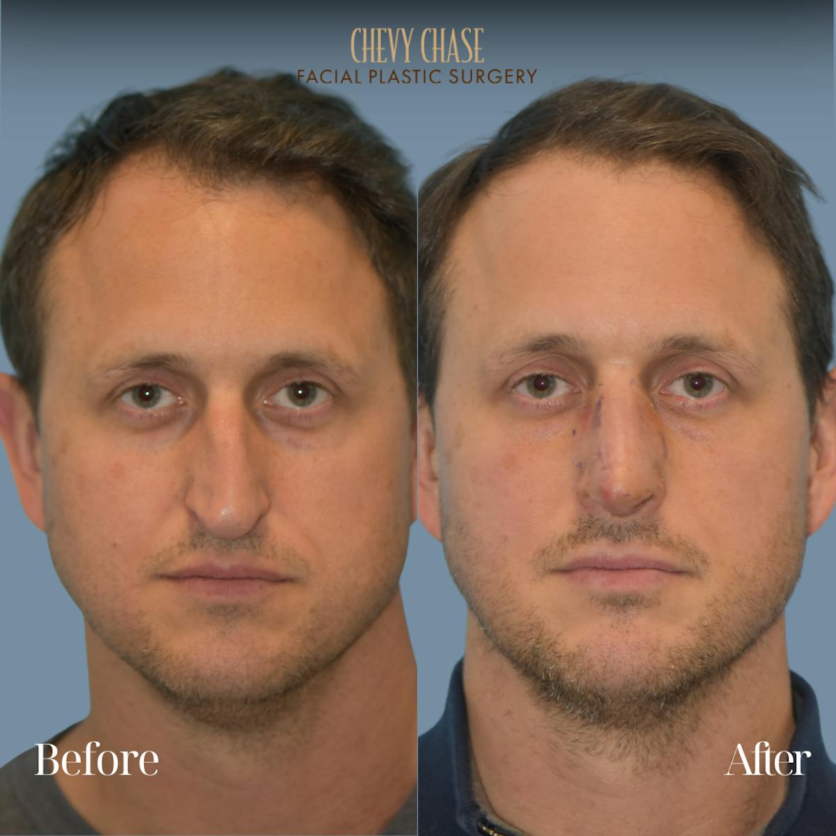 Rhinoplasty Before & After Gallery - Patient 360250 - Image 2