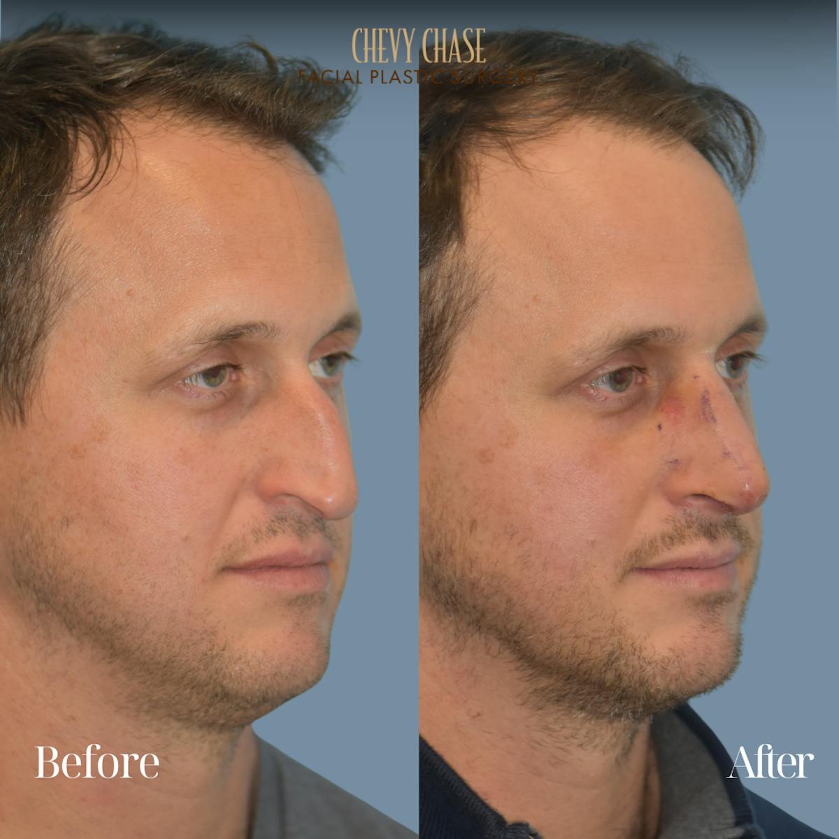 Rhinoplasty Before & After Gallery - Patient 360250 - Image 4