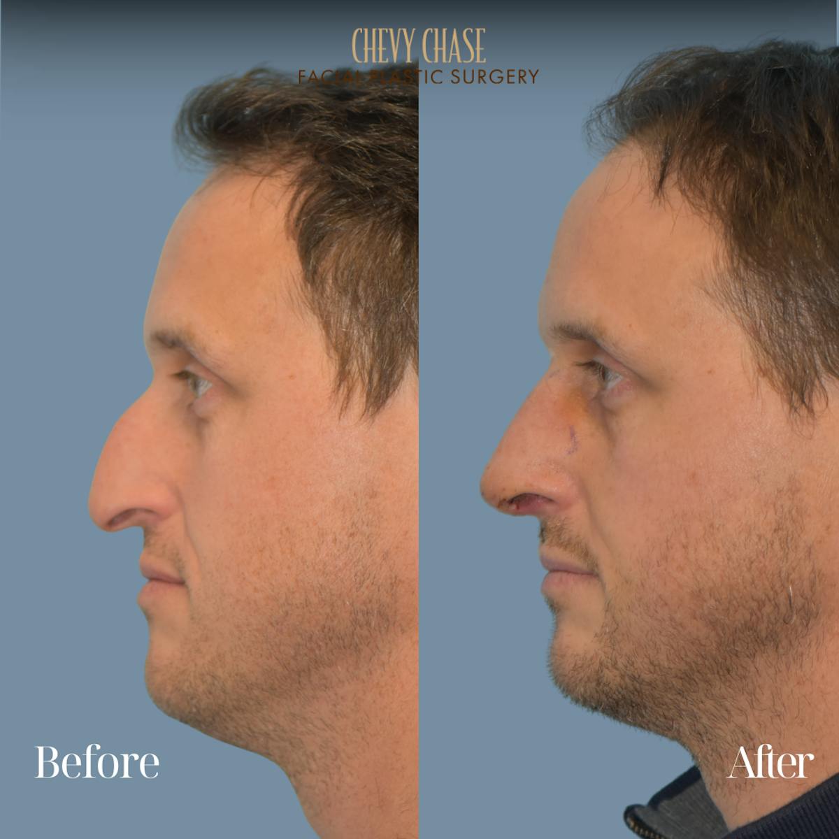 Rhinoplasty Before & After Gallery - Patient 360250 - Image 1