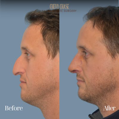 Rhinoplasty Before & After Gallery - Patient 360250 - Image 1