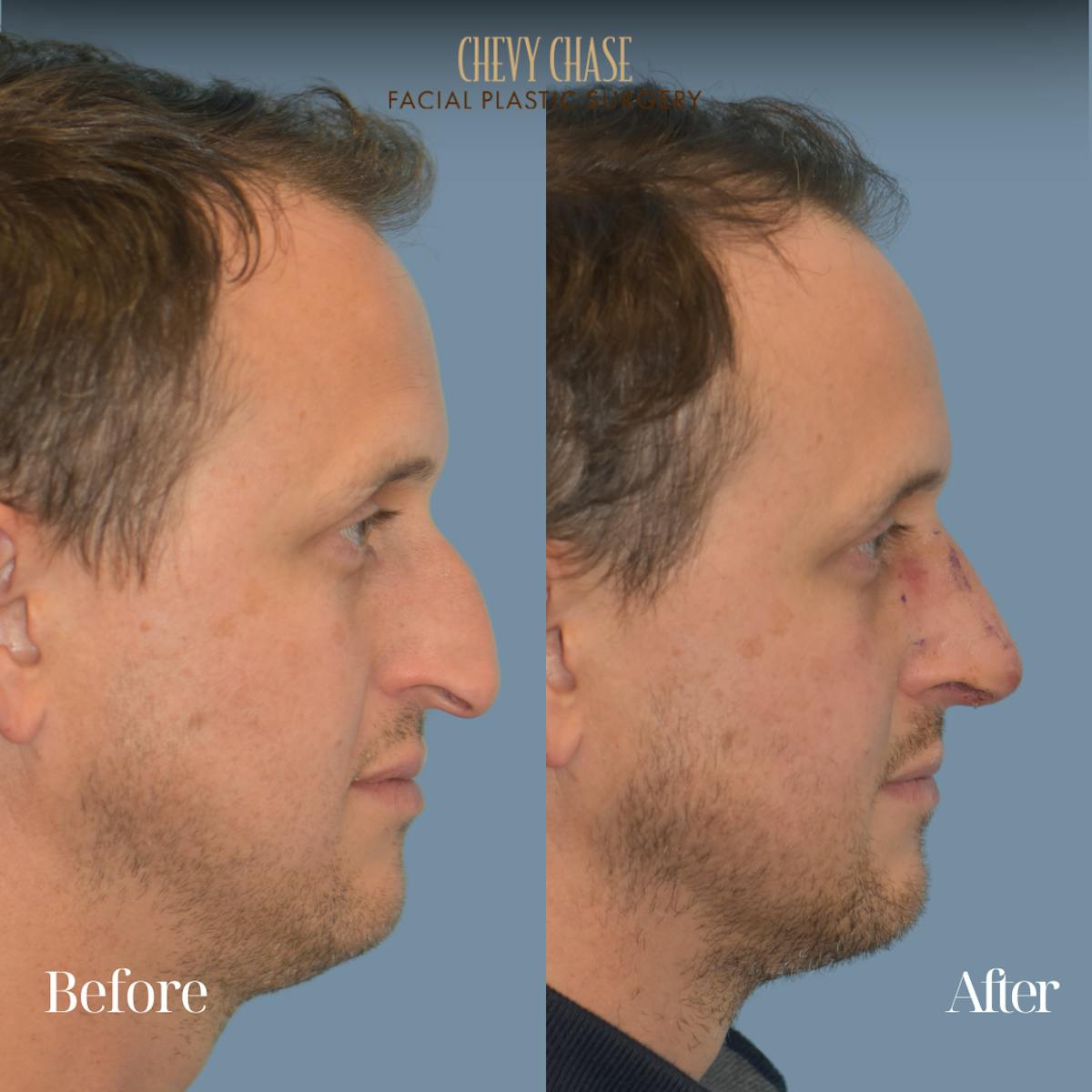 Rhinoplasty Before & After Gallery - Patient 360250 - Image 5