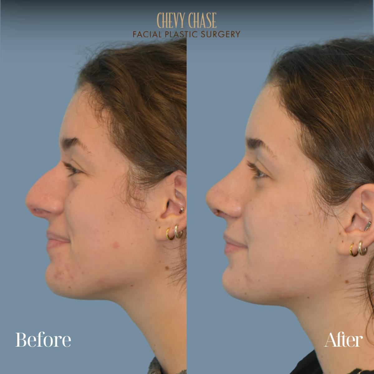 Rhinoplasty Before & After Gallery - Patient 204437 - Image 2