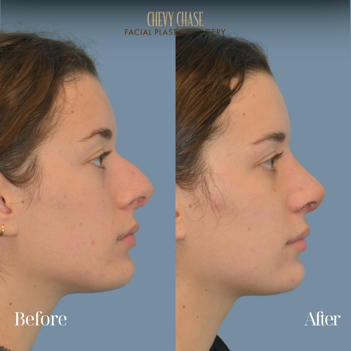 Rhinoplasty Before & After Gallery - Patient 204437 - Image 3