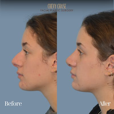 Rhinoplasty Before & After Gallery - Patient 204437 - Image 1
