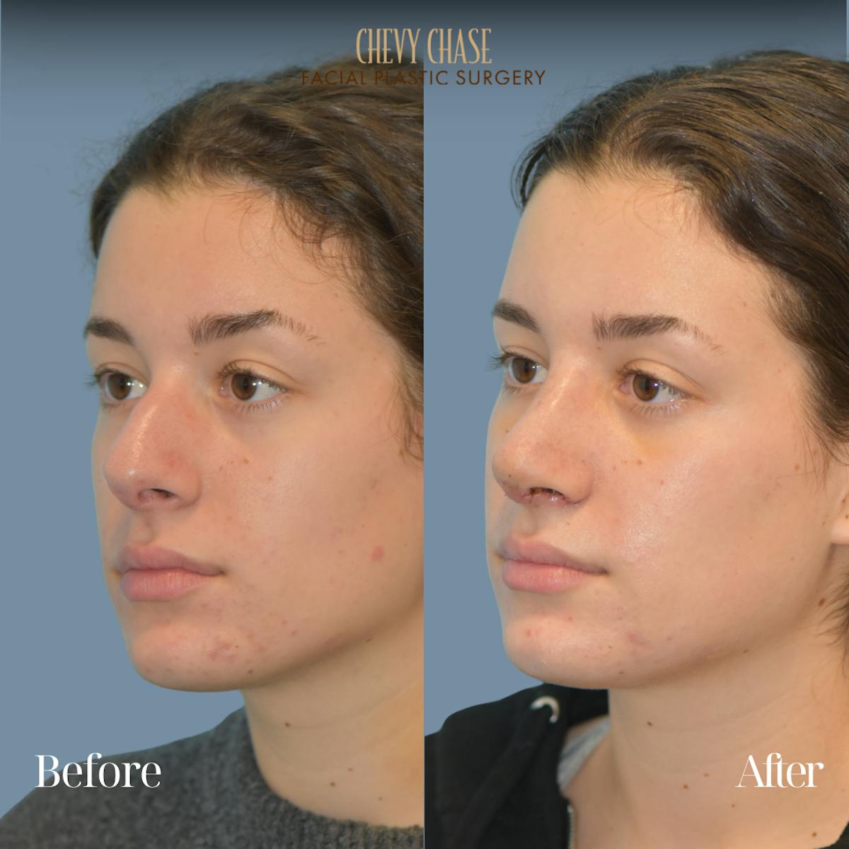 Rhinoplasty Before & After Gallery - Patient 204437 - Image 4