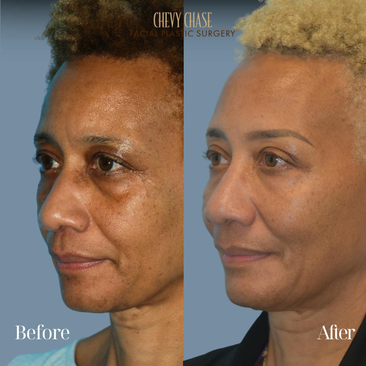 Botox® / Wrinkle Treatments Before & After Gallery - Patient 306550 - Image 4