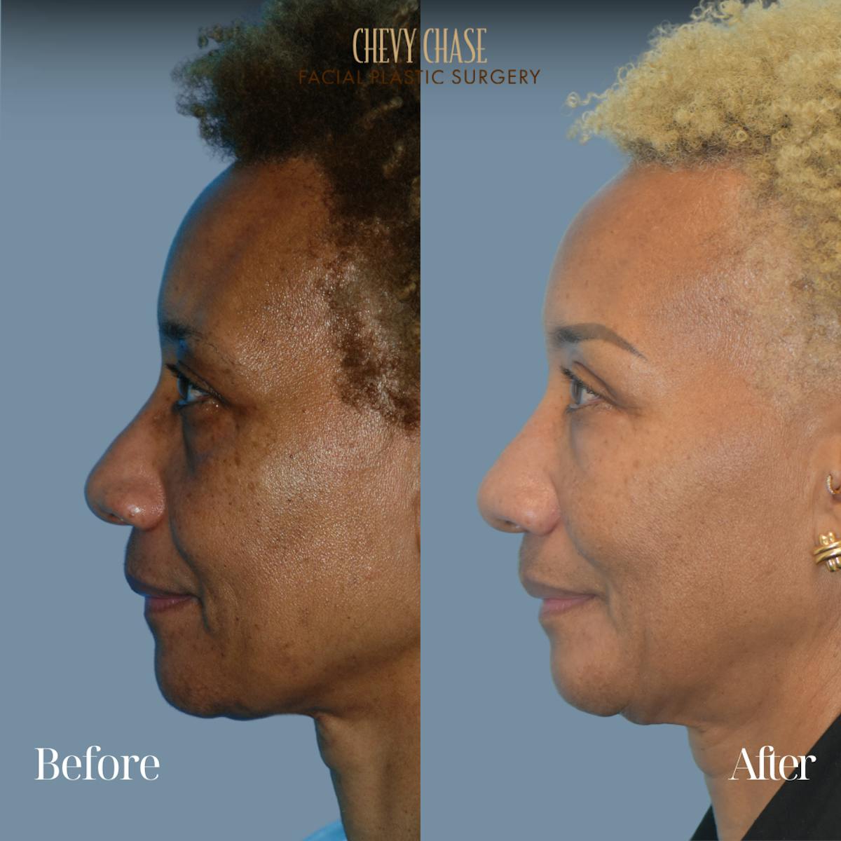 Botox® / Wrinkle Treatments Before & After Gallery - Patient 306550 - Image 5
