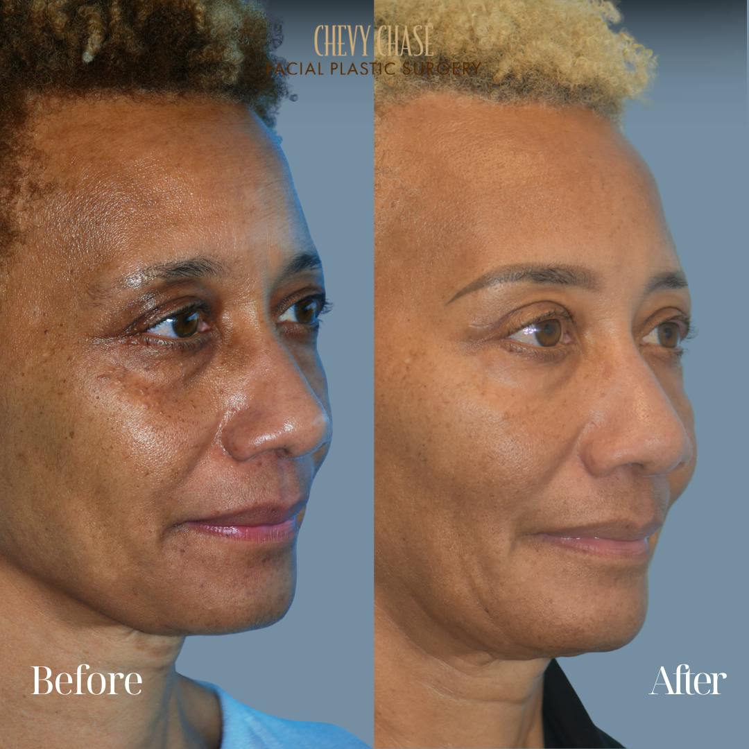 Botox® / Wrinkle Treatments Before & After Gallery - Patient 306550 - Image 2