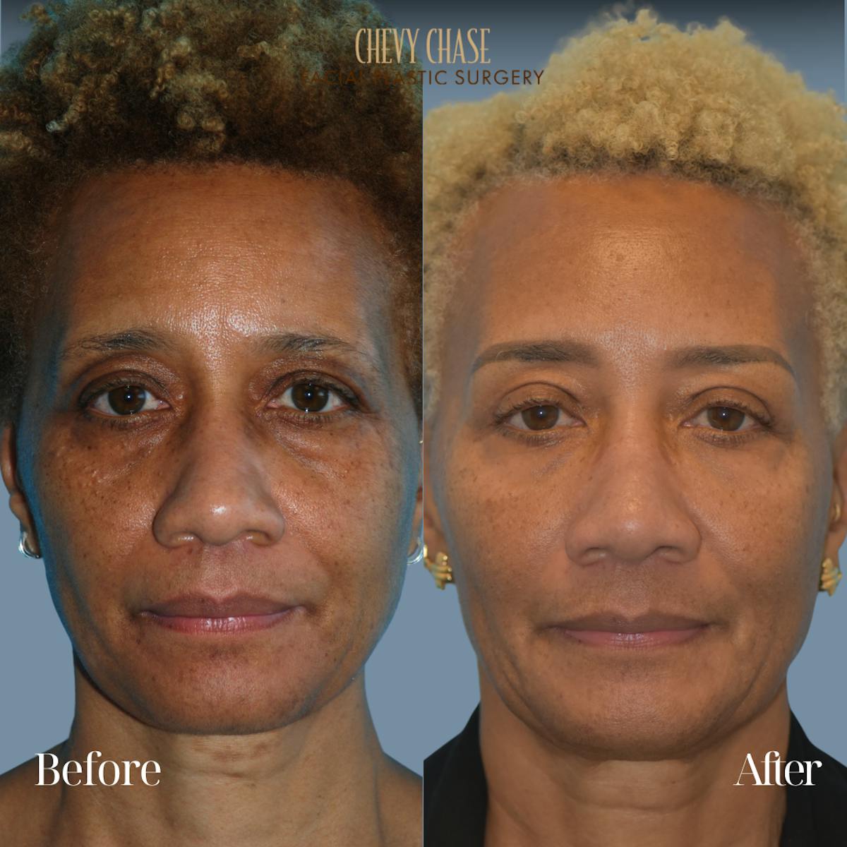 Botox® / Wrinkle Treatments Before & After Gallery - Patient 306550 - Image 1