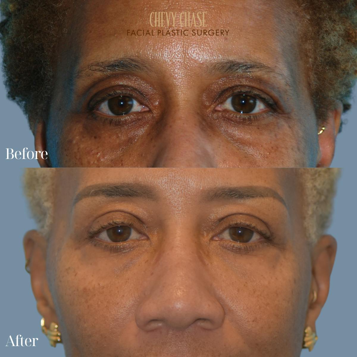 Blepharoplasty Before & After Gallery - Patient 133785 - Image 1