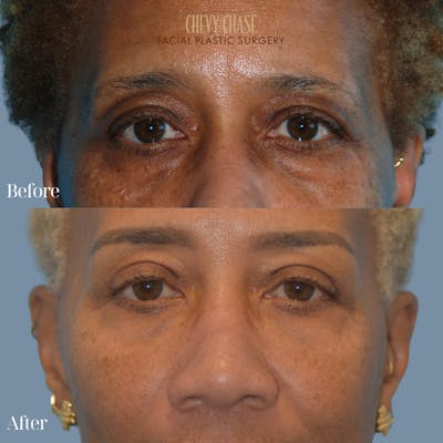 Blepharoplasty Before & After Gallery - Patient 133785 - Image 1