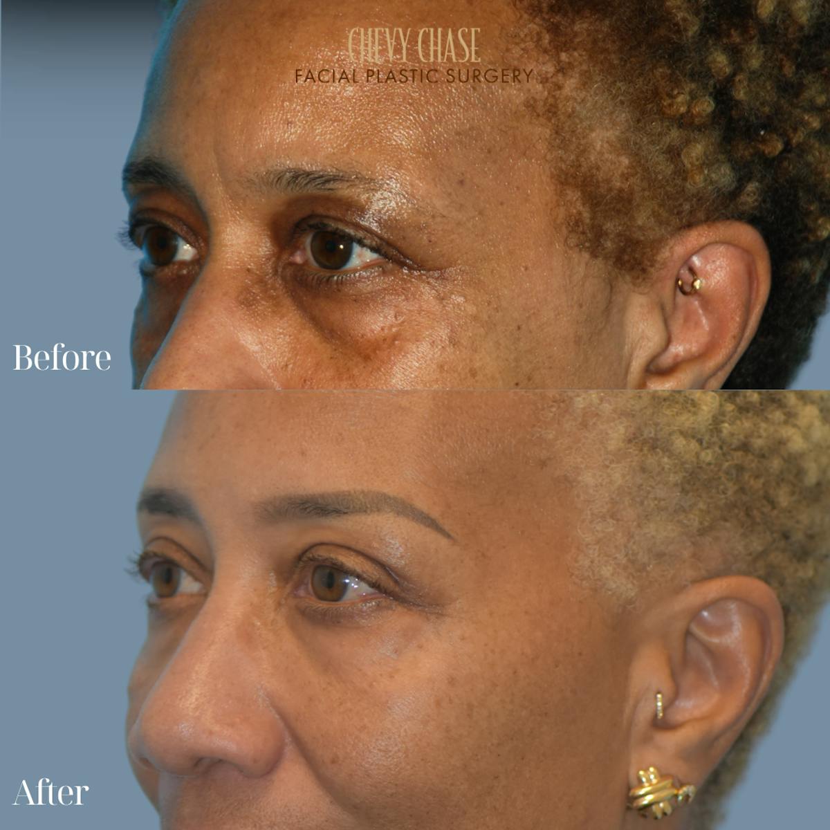 Blepharoplasty Before & After Gallery - Patient 133785 - Image 3