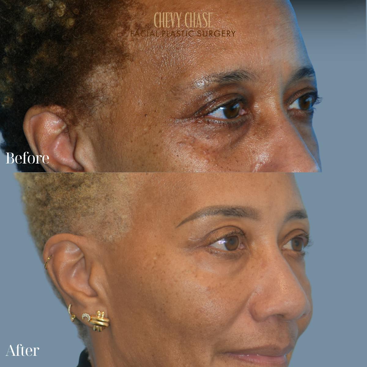 Blepharoplasty Before & After Gallery - Patient 133785 - Image 2