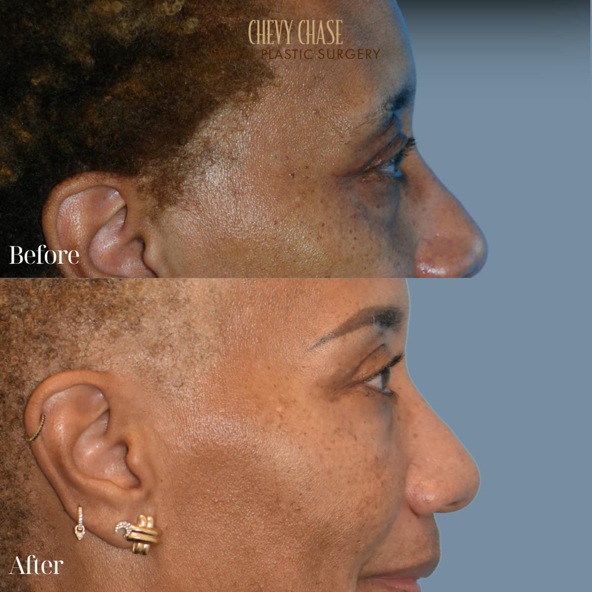 Blepharoplasty Before & After Gallery - Patient 133785 - Image 5