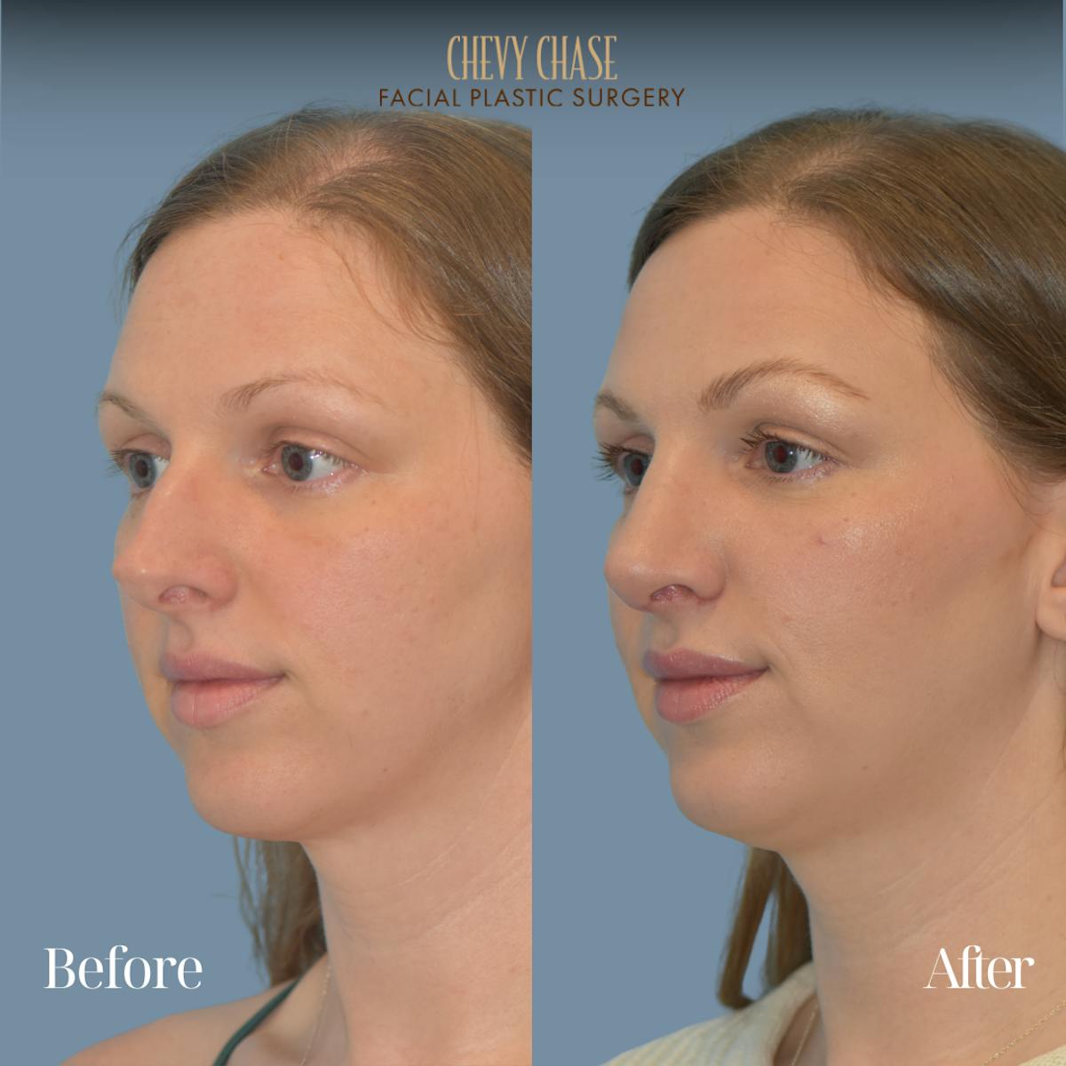 Rhinoplasty Before & After Gallery - Patient 118622 - Image 2