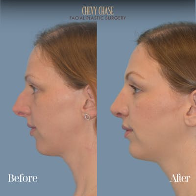 Rhinoplasty Before & After Gallery - Patient 118622 - Image 1