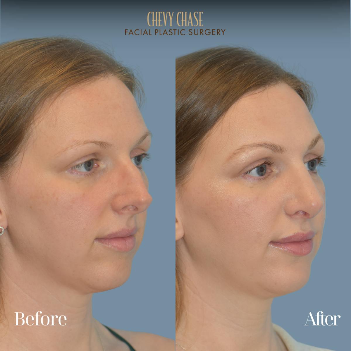 Rhinoplasty Before & After Gallery - Patient 118622 - Image 4