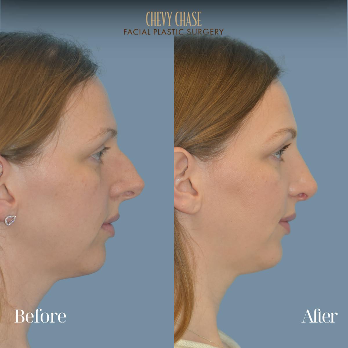 Rhinoplasty Before & After Gallery - Patient 118622 - Image 5