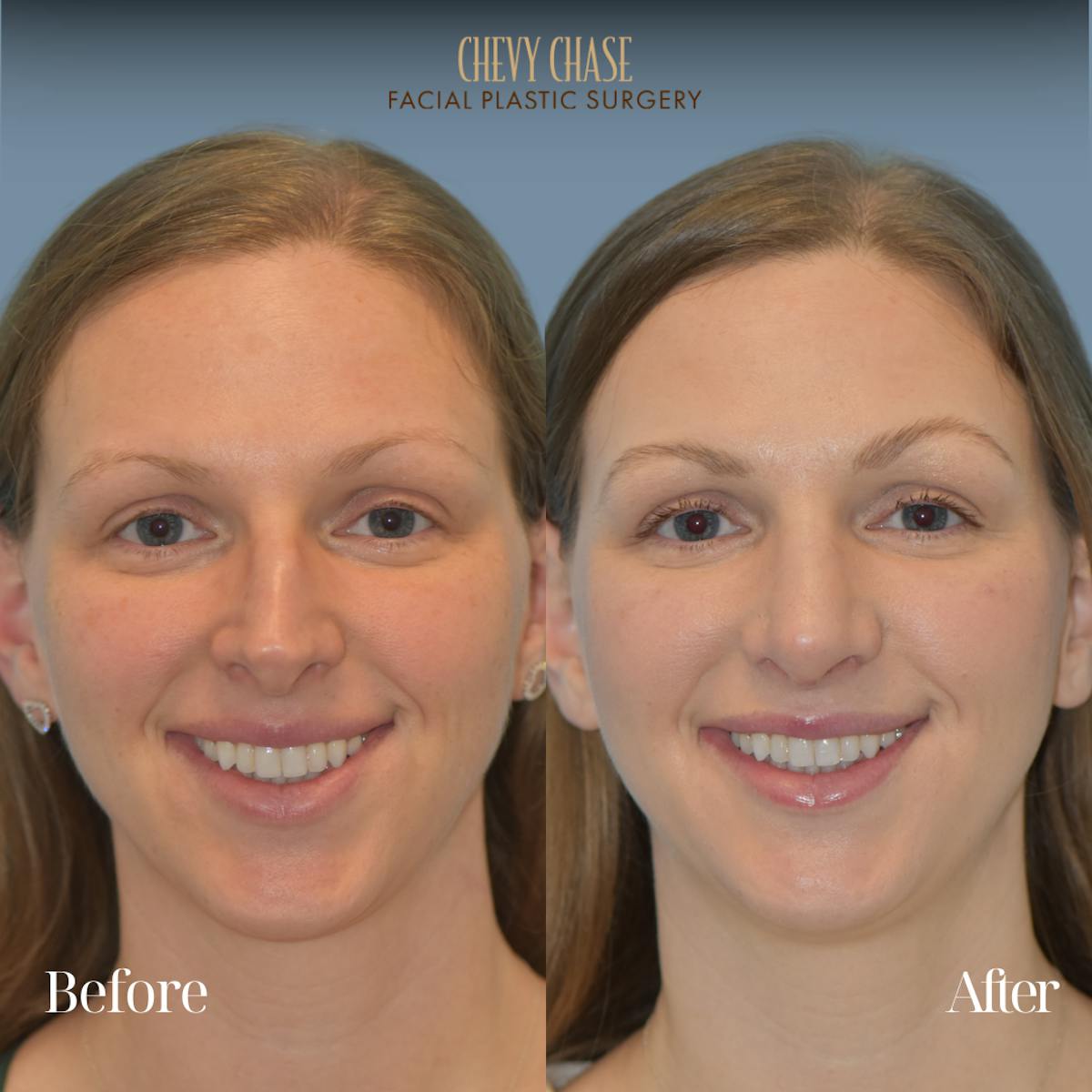 Rhinoplasty Before & After Gallery - Patient 118622 - Image 6