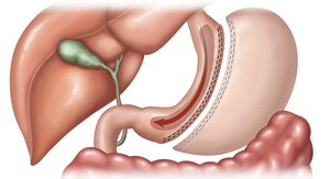 gastric sleeve