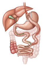 Gastric Bypass