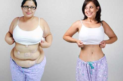 Before and After Gastric Sleeve Surgery - Las Vegas