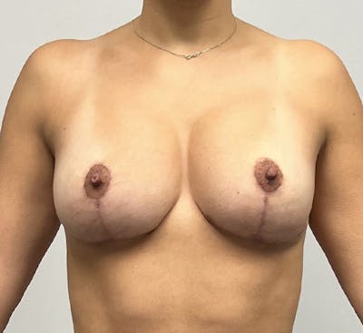 Breast Lift Before & After Gallery - Patient 93879144 - Image 2