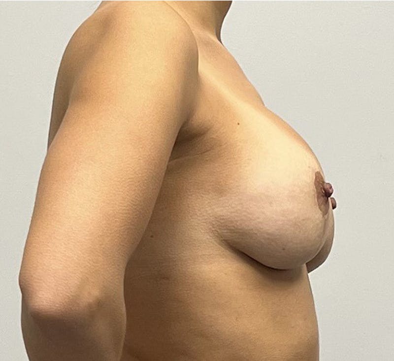 Breast Lift Before & After Gallery - Patient 93879144 - Image 5
