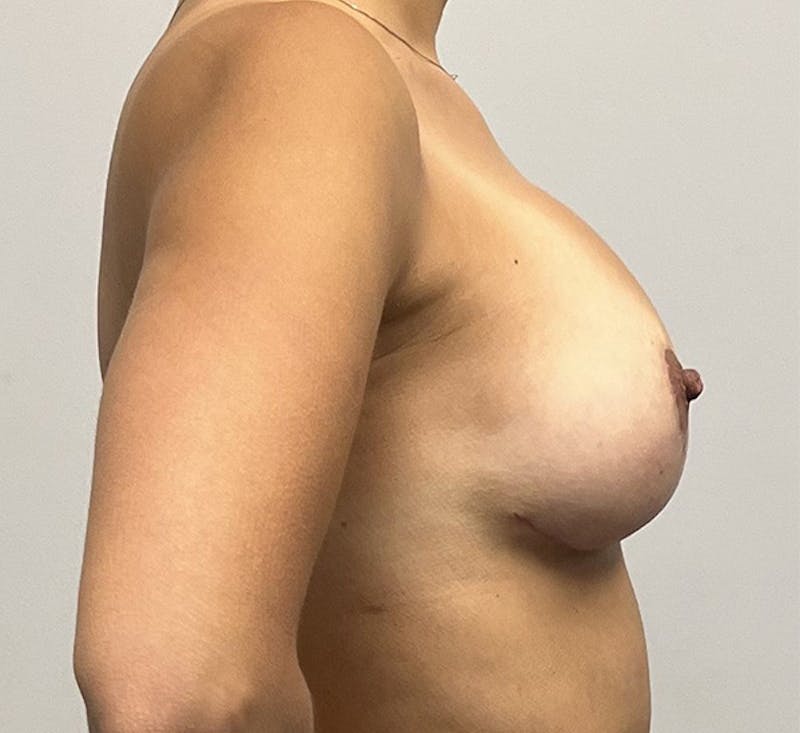 Breast Lift Before & After Gallery - Patient 93879144 - Image 6