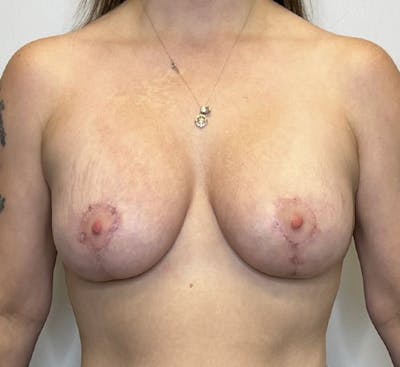 Breast Augmentation with Mastopexy Before & After Gallery - Patient 93879180 - Image 2
