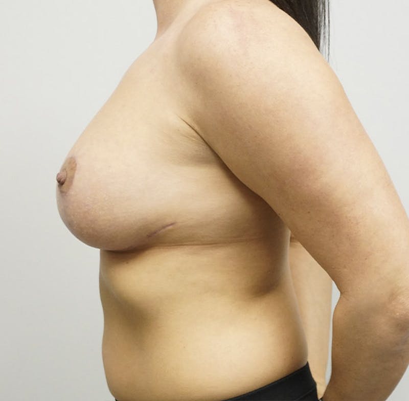 Breast Lift Before & After Gallery - Patient 93879151 - Image 4