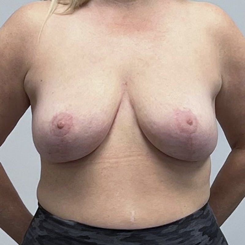 Breast Reduction Before & After Gallery - Patient 93879177 - Image 2
